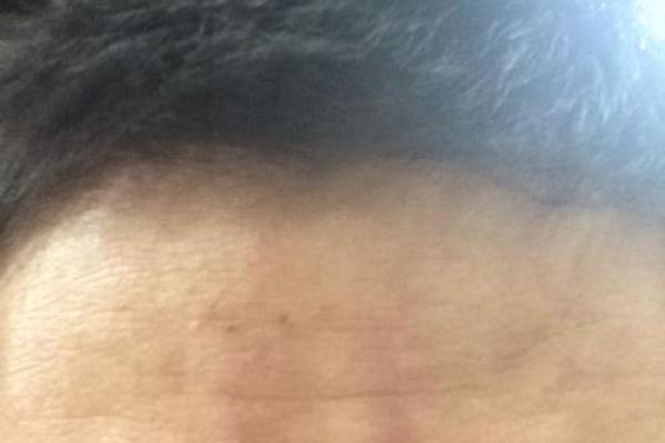 额头胎记算命图解 额头胎记算命图解