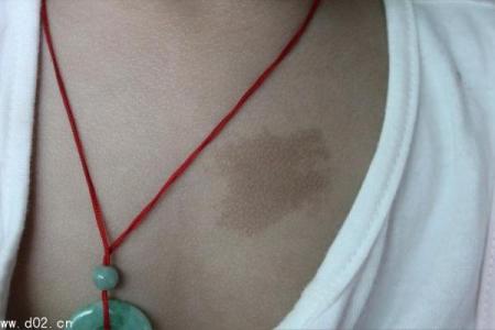 胎记算命的方法