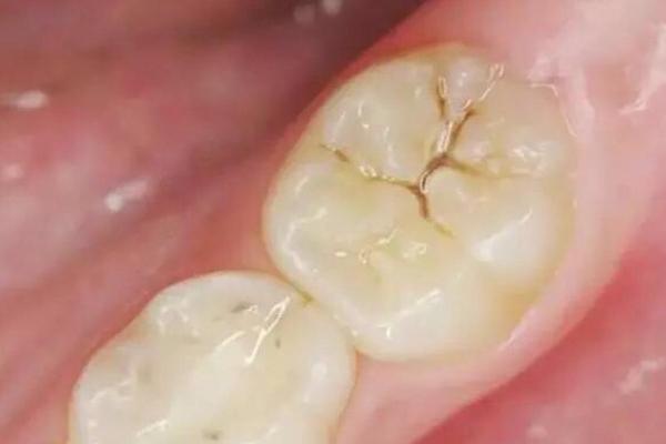 牙齿算命 有鬼牙不吉利吗