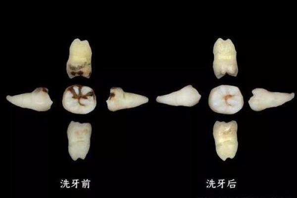 牙齿算命 有鬼牙不吉利吗