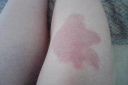 胎记算命：怎么看胎记