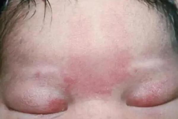 看脸上胎记如何算命