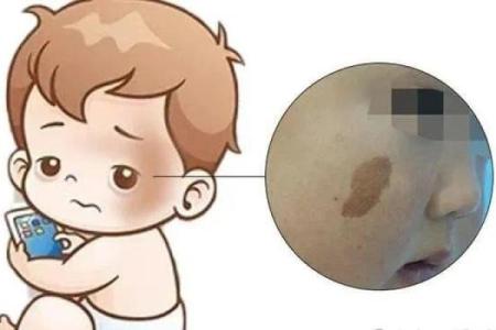 胎记的位置与算命图解