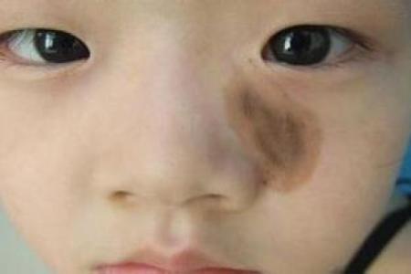 胎记算命：从胎记看运势