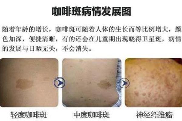 人体胎记算命的解释分析