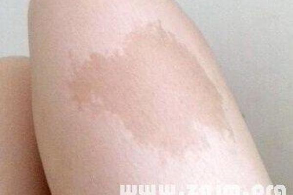 胎记释义,胎记算命中代表什么 胎记释义,胎记算命中代表什么