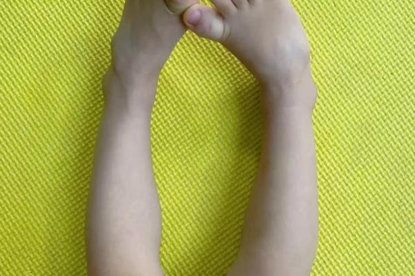 儿童内八字脚
