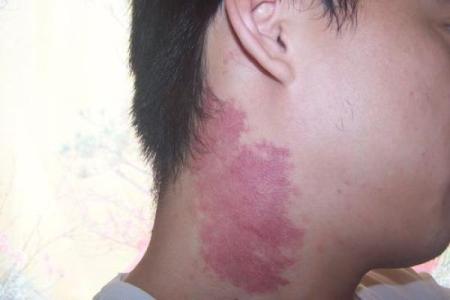 腰部上的胎记如何算命分析？