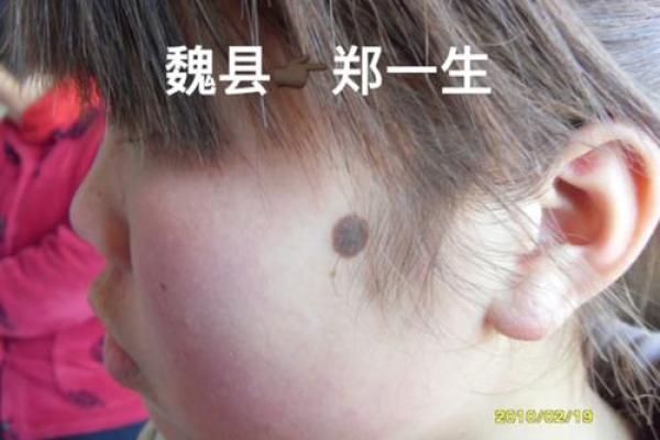 黑色胎记算命分析 黑色胎记算命分析
