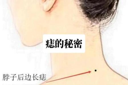脖子上的胎记算命