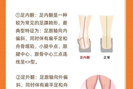 内八字、外八字孩子脚型正常不正常，家长可以这么判断