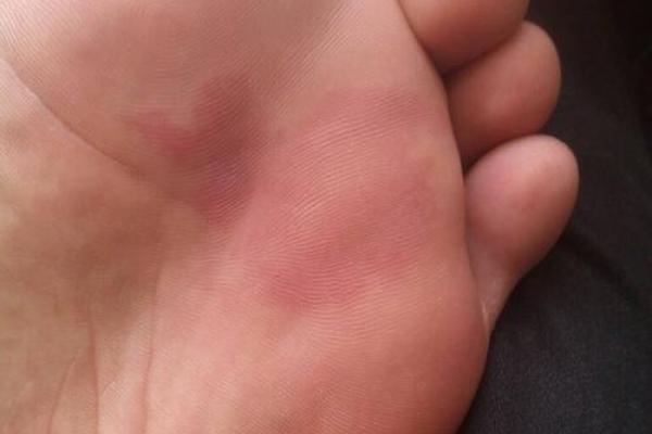 腿上胎记算命分析