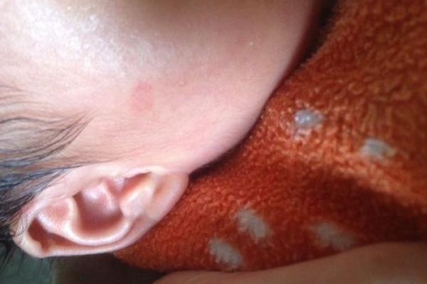 红色胎记算命看危害