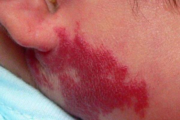 红色胎记算命看危害