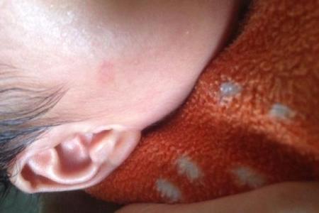 红色胎记算命看危害