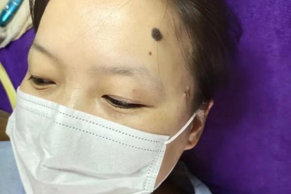 额头长胎记算命一生