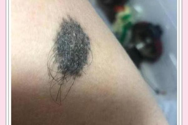 额头上的胎记算命