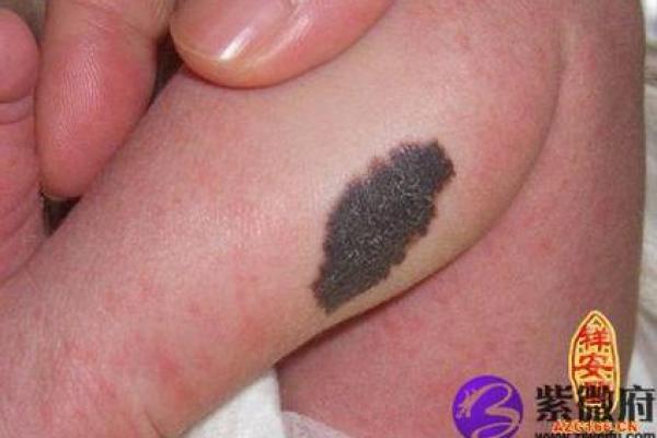 胎记算命大全 胎记算命大全