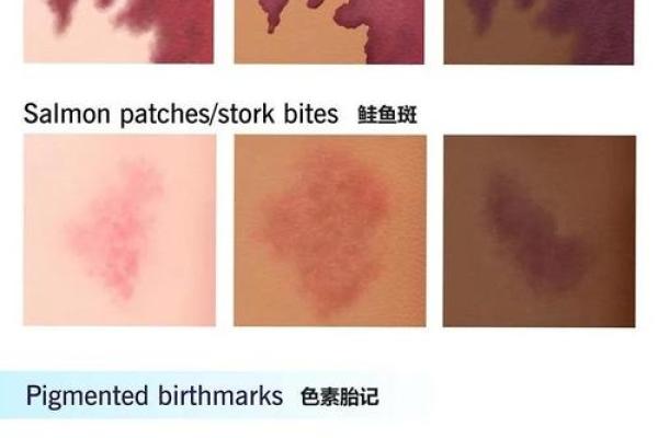 胎记算命图解:什么是红胎记? 胎记算命图解:什么是红胎记?