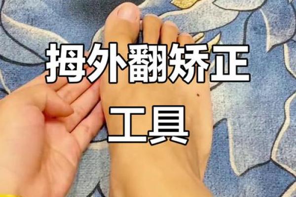 纠正外八字脚 纠正外八字脚