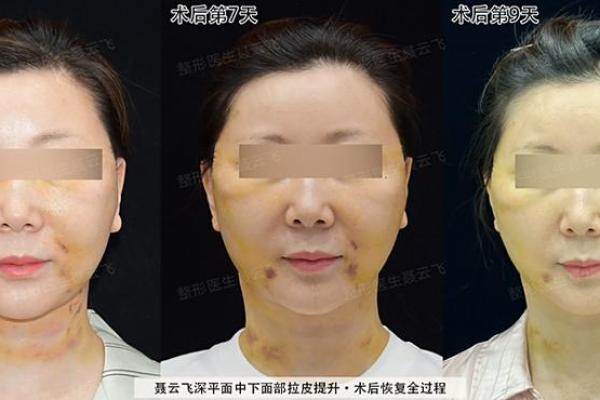 下巴八字纹 下巴八字纹