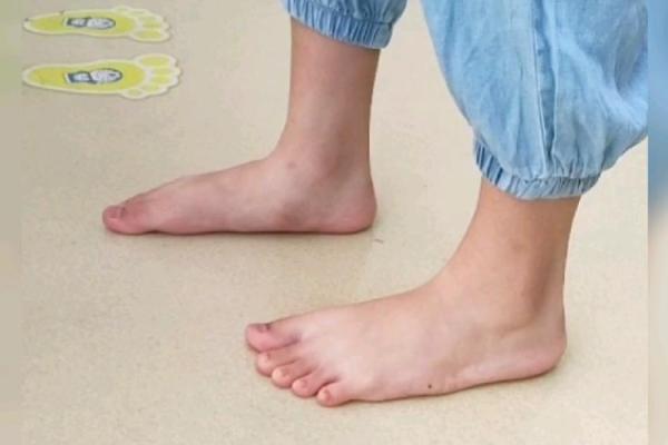 内八字原来有这么多伤害!吓得我赶紧比直脚走路 内八字原来有这么多伤害!吓得我赶紧比直脚走路