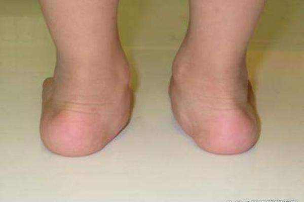 足脊健康知识小课堂（第三期） -  外八字篇